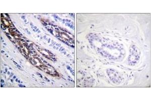 Immunohistochemistry analysis of paraffin-embedded human breast carcinoma tissue, using IRAK1 (Ab-209) Antibody. (IRAK1 抗体  (AA 175-224))