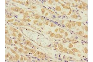 Immunohistochemistry of paraffin-embedded human gastric cancer using ABIN7173562 at dilution of 1:100 (Tropomyosin 4 抗体  (AA 1-248))