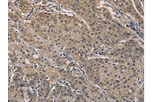 The image on the left is immunohistochemistry of paraffin-embedded Human gastric cancer tissue using ABIN7128303(AGTRAP Antibody) at dilution 1/40, on the right is treated with fusion protein. (AGTRAP 抗体)