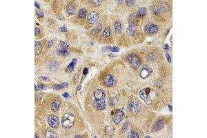 Immunohistochemical analysis of PYGB staining in human liver cancer formalin fixed paraffin embedded tissue section.