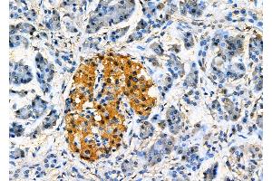 ABIN6265623 and ABIN6277829 at 1/100 staining Human pancreatic cancer and adjacent nomal tissues by IHC-P. (TMX2 抗体  (N-Term))