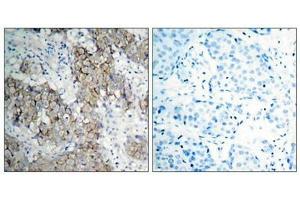 Immunohistochemical analysis of paraffin- embedded human breast carcinoma tissue using IGF-1R (phospho-Tyr1161) antibody. (IGF1R 抗体  (pTyr1161))