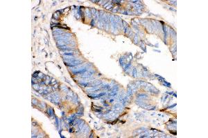 Anti- HRG antibody, IHC(P) IHC(P): Human Intestinal Cancer Tissue (HRG 抗体  (AA 19-200))