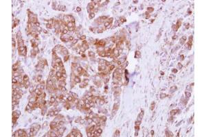 IHC-P Image Immunohistochemical analysis of paraffin-embedded human breast cancer, using OCRL, antibody at 1:250 dilution. (OCRL 抗体  (C-Term))