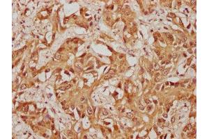 IHC image of ABIN7174320 diluted at 1:100 and staining in paraffin-embedded human liver cancer performed on a Leica BondTM system. (USP36 抗体  (AA 670-881))