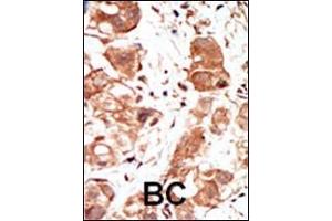 Formalin-fixed and paraffin-embedded human cancer tissue reacted with the primary antibody, which was peroxidase-conjugated to the secondary antibody, followed by DAB staining. (PIM1 抗体  (C-Term))