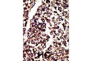 Formalin-fixed and paraffin-embedded human hepatocellular carcinoma tissue reacted with AGER polyclonal antibody  , which was peroxidase-conjugated to the secondary antibody, followed by AEC staining . (RAGE 抗体  (C-Term))