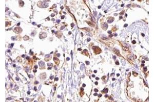 ABIN6267475 at 1/100 staining human breast carcinoma tissue sections by IHC-P. (AKT2 抗体  (pSer474))