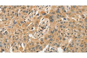 Immunohistochemistry of paraffin-embedded Human lung cancer tissue using SLC11A2 Polyclonal Antibody at dilution 1:50 (SLC11A2 抗体)