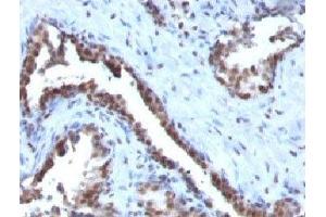 Formalin-fixed, paraffin-embedded human prostate carcinoma stained with Cyclin B1 antibody. (Cyclin B1 抗体)
