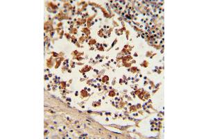 Formalin-fixed and paraffin-embedded human lymph tissue with Bcl-6 Antibody (C-term), which was peroxidase-conjugated to the secondary antibody, followed by DAB staining. (BCL6 抗体  (C-Term))
