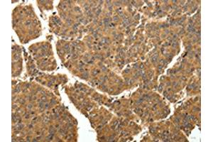 The image on the left is immunohistochemistry of paraffin-embedded Human liver cancer tissue using ABIN7129340(EIF2AK3 Antibody) at dilution 1/40, on the right is treated with fusion protein. (COQ3 抗体)