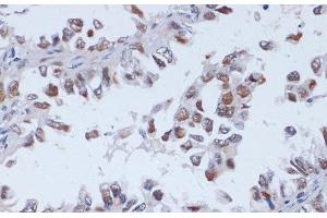 Immunohistochemistry of paraffin-embedded Human lung cancer using DNMT3L Polyclonal Antibody at dilution of 1:100 (40x lens).