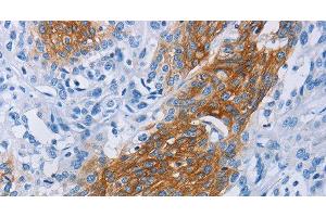 Immunohistochemistry of paraffin-embedded Human esophagus cancer tissue using CCR9 Polyclonal Antibody at dilution 1:60 (CCR9 抗体)