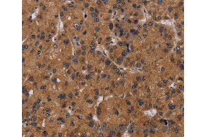 Immunohistochemistry of Human thyroid cancer using NPRL2 Polyclonal Antibody at dilution of 1:50 (NPRL2 抗体)