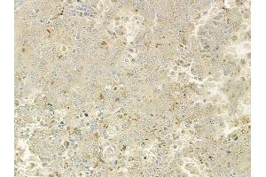 ABIN6264150 and ABIN6277603 at 1/100 staining human melanoma by IHC-P. (PEX19 抗体  (Internal Region))