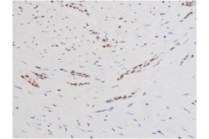 ABIN6267579 at 1/200 staining Human bladder cancer tissue sections by IHC-P. (FOXO4 抗体  (pSer197))