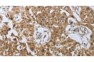 Immunohistochemistry of paraffin-embedded Human lung cancer using PSMD6 Polyclonal Antibody at dilution of 1:40