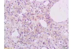 Formalin-fixed and paraffin embedded human cervical carcinoma labeled with Anti Phospho-S6 Ribosomal Protein (Ser235+Ser236) Polyclonal Antibody, Unconjugated (ABIN745583) at 1:200 followed by conjugation to the secondary antibody and DAB staining (RPS6 抗体  (pSer235, pSer236))
