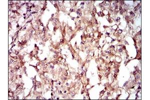 Immunohistochemical analysis of paraffin-embedded renal cancer tissues using GUCY1A3 mouse mAb with DAB staining. (GUCY1A1 抗体  (AA 22-214))