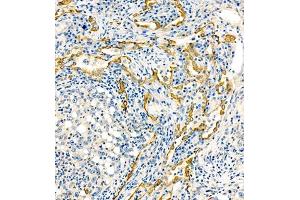 Immunohistochemistry of paraffin embedded human lung cancer using MRP1 (ABIN7074544) at dilution of 1:1000 (200x lens) (MRP1 抗体)