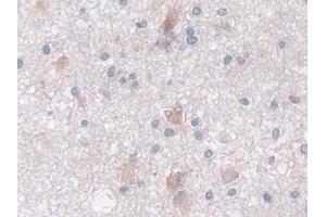 Detection of IDH2 in Human Glioma Tissue using Polyclonal Antibody to Isocitrate Dehydrogenase 2, mitochondrial (IDH2)