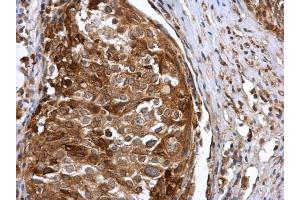 IHC-P Image IFIT3 antibody detects IFIT3 protein at cytoplasm in human cervical carcinoma by immunohistochemical analysis. (IFIT3 抗体)