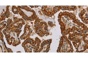 Immunohistochemistry of paraffin-embedded Human thyroid cancer using NDUFS5 Polyclonal Antibody at dilution of 1:50