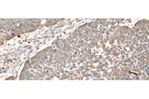 Immunohistochemistry of paraffin-embedded Human lung cancer tissue using DPH7 Polyclonal Antibody at dilution of 1:40(x200) (Diphthamide Biosynthesis 7 (DPH7) 抗体)