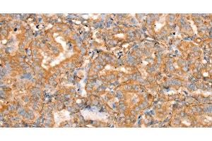 Immunohistochemistry of paraffin-embedded Human thyroid cancer using SLC16A8 Polyclonal Antibody at dilution of 1:40 (MCT3 抗体)