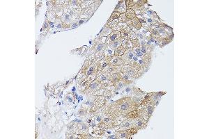Immunohistochemistry of paraffin-embedded human liver cancer using GN Rabbit pAb (ABIN3023414, ABIN3023415, ABIN3023416 and ABIN6219781) at dilution of 1:150 (40x lens). (GNA11 抗体)