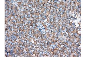 Immunohistochemical staining of paraffin-embedded Adenocarcinoma of Human colon tissue using anti-EIF2S1 mouse monoclonal antibody.