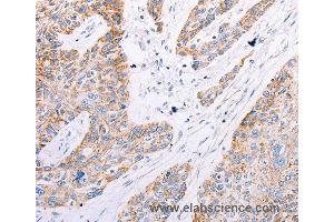 Immunohistochemistry of Human esophagus cancer using GFRA3 Polyclonal Antibody at dilution of 1:60 (GFRA3 抗体)