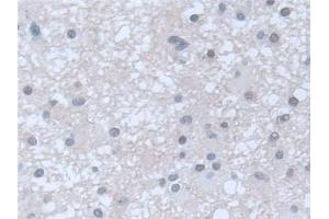 Detection of GUCY1b3 in Human Glioma Tissue using Polyclonal Antibody to Guanylate Cyclase 1 Beta 3 (GUCY1b3) (GUCY1B3 抗体  (AA 408-619))