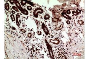 Immunohistochemistry (IHC) analysis of paraffin-embedded Human Breast Cancer, antibody was diluted at 1:100. (p53 抗体  (Internal Region))