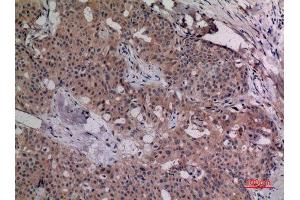 Immunohistochemistry (IHC) analysis of paraffin-embedded Human Breast Cancer, antibody was diluted at 1:100. (IL-4 抗体  (Internal Region))