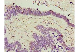 Immunohistochemistry of paraffin-embedded human ovarian cancer using ABIN7174864 at dilution of 1:100 (C6orf141 抗体  (AA 1-237))
