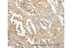 Immunohistochemistry of Human lung cancer using ACE Polyclonal Antibody at dilution of 1:70 (Angiotensin I Converting Enzyme 1 抗体)