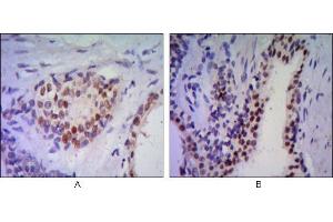 Immunohistochemical analysis of paraffin-embedded human prostata tissues (A, B) using anti-NKX3A antibody with DAB staining.