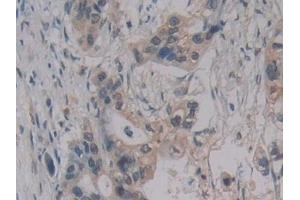 Detection of MPG1 in Human Pancreatic cancer Tissue using Polyclonal Antibody to Macrophage Expressed Gene 1 Protein (MPG1) (MPEG1 抗体  (AA 313-580))