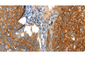Immunohistochemistry of paraffin-embedded Human cervical cancer tissue using VWA5A Polyclonal Antibody at dilution 1:80 (VWA5A 抗体)
