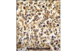 CCDC19 Antibody (N-term) (ABIN654396 and ABIN2844138) immunohistochemistry analysis in formalin fixed and paraffin embedded human testis carcinoma followed by peroxidase conjugation of the secondary antibody and DAB staining. (CCDC19 抗体  (N-Term))