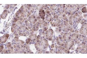 ABIN6273226 at 1/100 staining Human pancreas cancer tissue by IHC-P. (DIO1 抗体  (C-Term))
