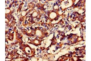 Immunohistochemistry of paraffin-embedded human gastric cancer using ABIN7160449 at dilution of 1:100 (FAM168B 抗体  (AA 43-100))