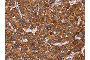 The image on the left is immunohistochemistry of paraffin-embedded Human liver cancer tissue using ABIN7190739(GAGE12I Antibody) at dilution 1/20, on the right is treated with synthetic peptide. (G Antigen 12I 抗体)