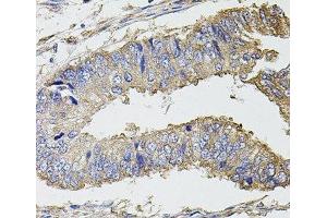 Immunohistochemistry of paraffin-embedded Human colon carcinoma using UBE2S Polyclonal Antibody at dilution of 1:100 (40x lens). (UBE2S 抗体)