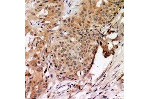 Immunohistochemical analysis of TAGAP staining in human breast cancer formalin fixed paraffin embedded tissue section. (TAGAP 抗体)