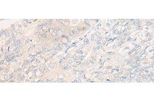 Immunohistochemistry of paraffin-embedded Human gastric cancer tissue using CYB5R3 Polyclonal Antibody at dilution of 1:50(x200)