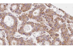 ABIN6273962 at 1/100 staining Human liver cancer tissue by IHC-P. (OR6C75 抗体)