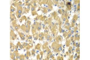 Immunohistochemistry of paraffin-embedded Human liver damage using MAP4K3 Polyclonal Antibody at dilution of 1:100 (40x lens). (MAP4K3 抗体)